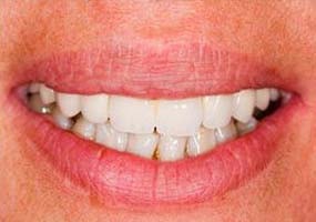  Les bridges dentaires peuvent littéralement combler le fossé créé par une ou plusieurs dents manquantes.

Un bridge est constitué de deux couronnes pour les dents de chaque côté de l’espace – ces deux dents d’ancrage sont appelées dents piliers – et une ou deux fausses dents entre les deux.

Ces fausses dents sont appelées pontiques et peuvent être fabriquées à partir d’or, d’alliages, de porcelaine, ou d’une combinaison de ces matériaux.

Les bridges dentaires sont pris en charge par des dents naturelles ou des implants. dentiste gagny villemomble urgence