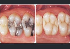 Les inlays/onlays sont des soins conservateurs qui permettent de restaurer des dents présentant des caries ou anciens plombages de volume important.

 

Après nettoyage de la carie et mise en forme de la dent, une empreinte est réalisée à l’aide d’une caméra d’empreinte optique ou bien de matériaux à empreinte classique. A partir de cette empreinte et des références de teinte, une pièce en céramique (ou parfois en résine composite) sur mesure appelée inlay (ou onlay) est réalisée au laboratoire de prothèse.

L’Inlay est ensuite collé à la dent au cours d’une seconde séance. dentiste gagny urgence