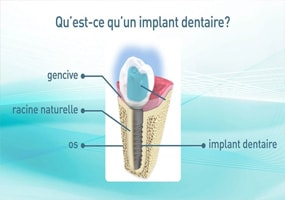 implant dentaire a Gagny