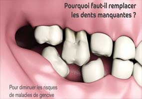 Pourquoi il faut remplacer les dents manquantes ?